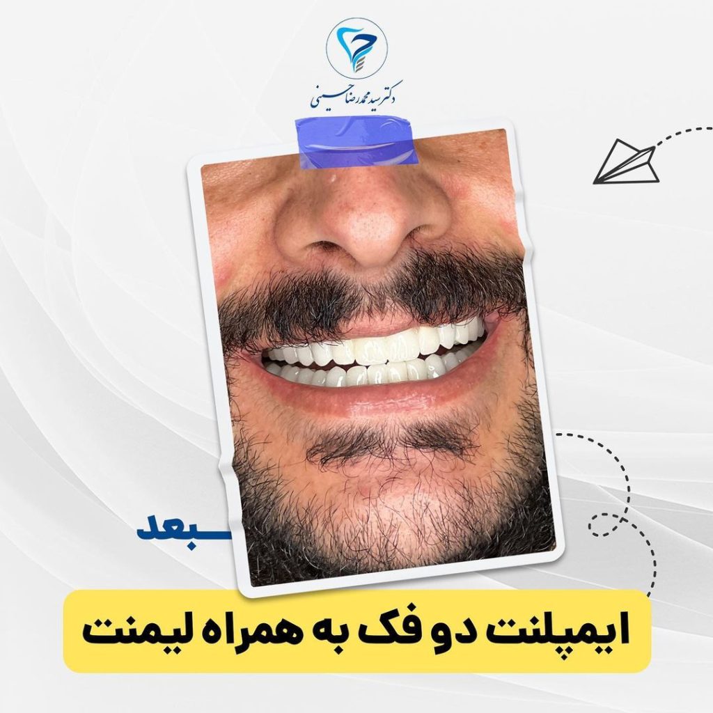 ایمپلنت دو فک به همراه لمینت بعد