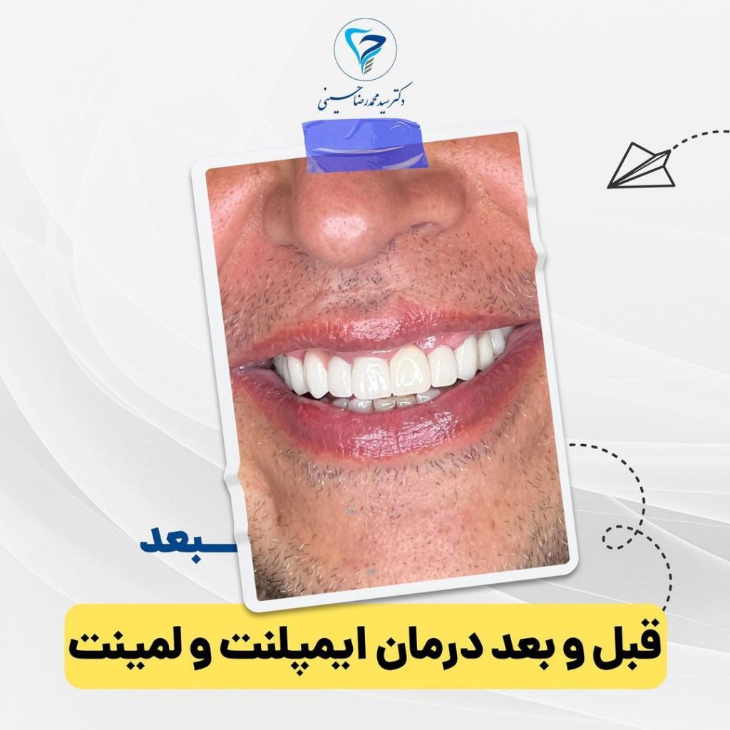 درمان ایمپلنت بعد