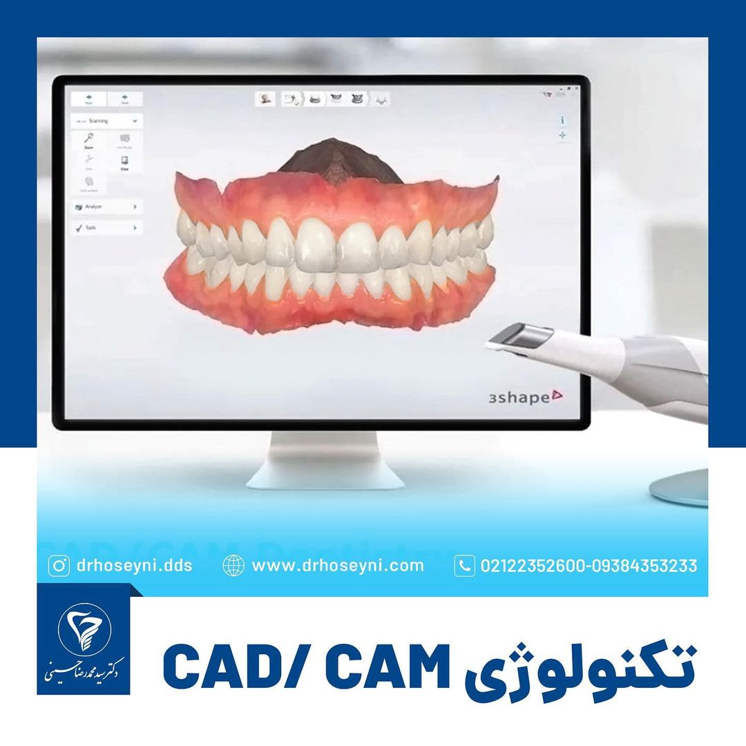 قیمت ایمپلنت دیجیتال در تهران