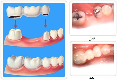 قیمت پروتز دیجیتال