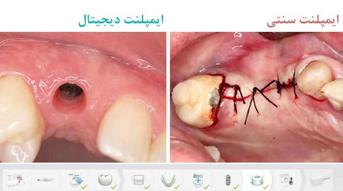 ایمپلنت سنتی و دیجیتال