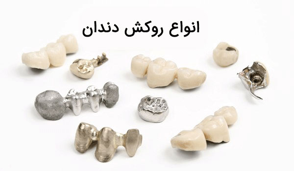 تفاوت انواع روکش دندان