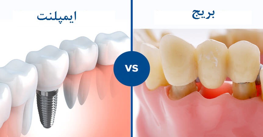 فرق بریج دندان با ایمپلنت