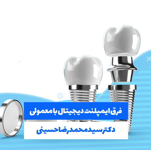 فرق ایمپلنت دیجیتال با معمولی