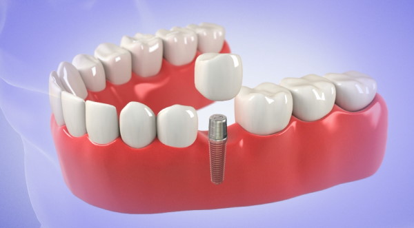 Implant In One Day