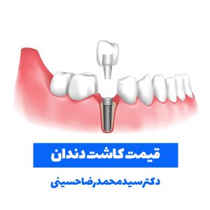 قیمت کاشت دندان