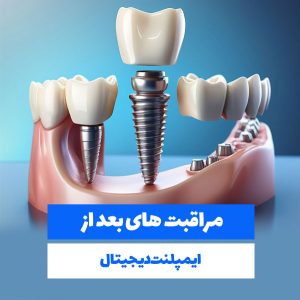 مراقبت های بعد از ایمپلنت دیجیتال